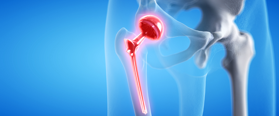 3d rendered medically accurate illustration of a painful hip rep